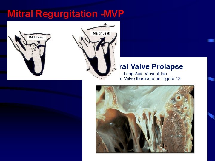 Mitral Regurgitation -MVP Mitral Regurgitation -MVP