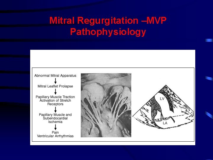 Mitral Regurgitation –MVP Pathophysiology Mitral Regurgitation –MVP Pathophysiology