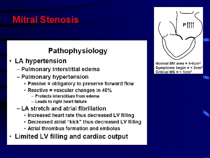 Mitral Stenosis Mitral Stenosis