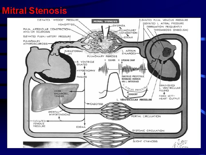 Mitral Stenosis Mitral Stenosis