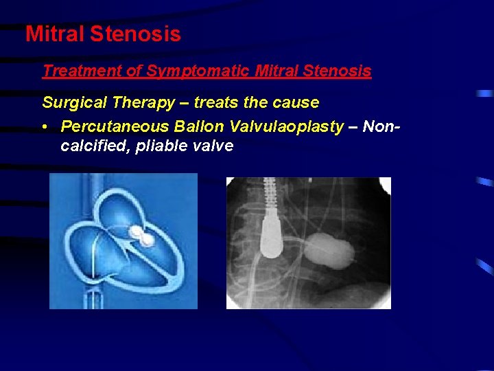 Mitral Stenosis Treatment of Symptomatic Mitral Stenosis Surgical Therapy – treats the cause • Mitral Stenosis Treatment of Symptomatic Mitral Stenosis Surgical Therapy – treats the cause •