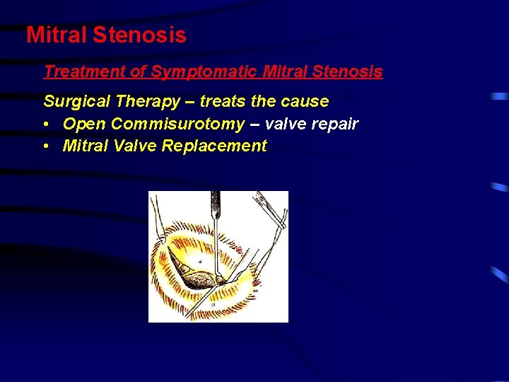 Mitral Stenosis Treatment of Symptomatic Mitral Stenosis Surgical Therapy – treats the cause • Mitral Stenosis Treatment of Symptomatic Mitral Stenosis Surgical Therapy – treats the cause •