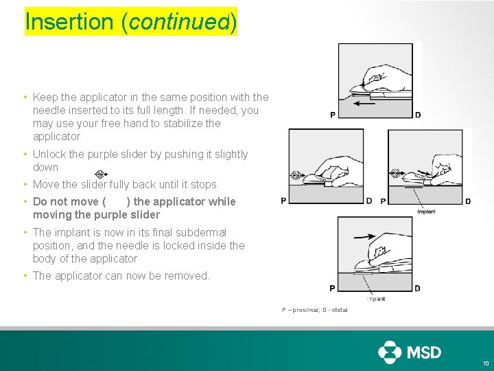 Insertion (continued) • Keep the applicator in the same position with the needle inserted