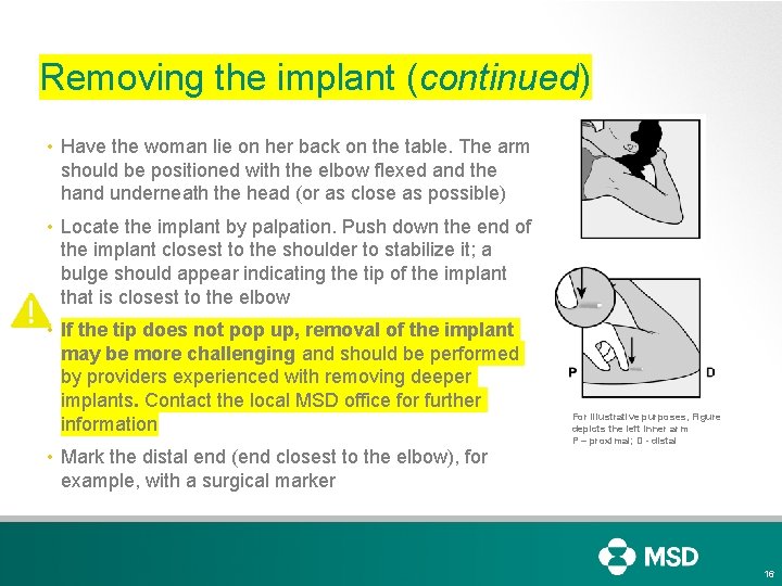 Removing the implant (continued) • Have the woman lie on her back on the