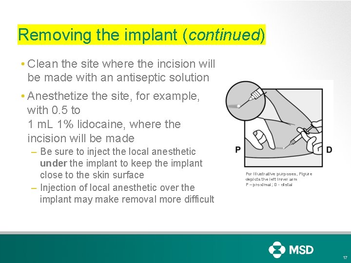 Removing the implant (continued) • Clean the site where the incision will be made