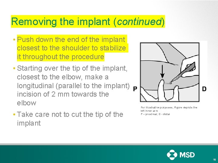 Removing the implant (continued) • Push down the end of the implant closest to