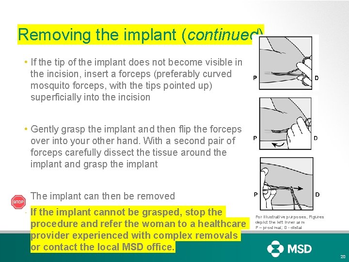 Removing the implant (continued) • If the tip of the implant does not become