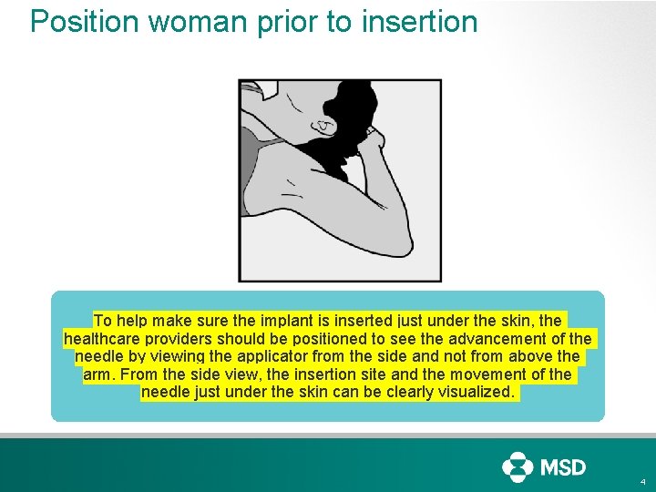Position woman prior to insertion To help make sure the implant is inserted just
