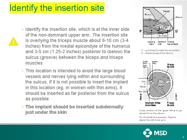 Identify the insertion site • Identify the insertion site, which is at the inner