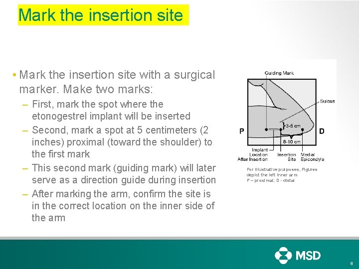 Mark the insertion site • Mark the insertion site with a surgical marker. Make