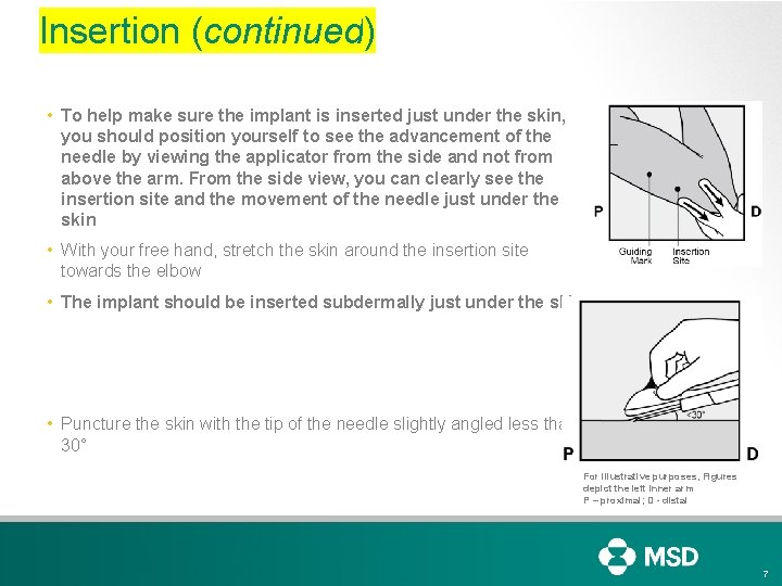 Insertion (continued) • To help make sure the implant is inserted just under the