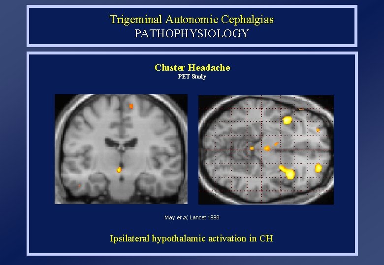 Trigeminal Autonomic Cephalgias PATHOPHYSIOLOGY Cluster Headache PET Study May et al, Lancet 1998 Ipsilateral