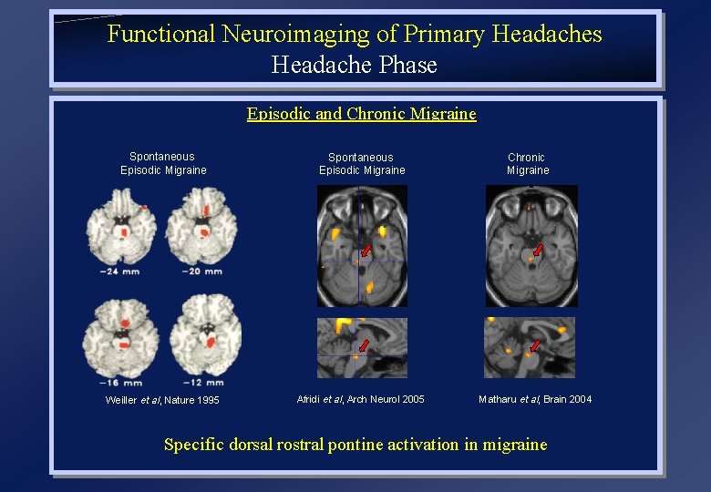 Functional Neuroimaging of Primary Headaches Headache Phase Episodic and Chronic Migraine Spontaneous Episodic Migraine