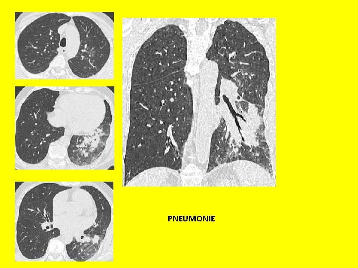 Pneumonie: tratament