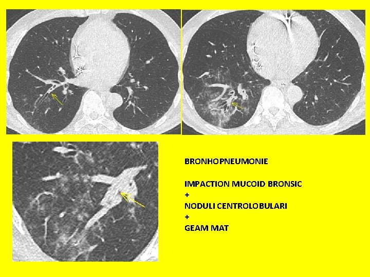 BRONHOPNEUMONIE IMPACTION MUCOID BRONSIC + NODULI CENTROLOBULARI + GEAM MAT 