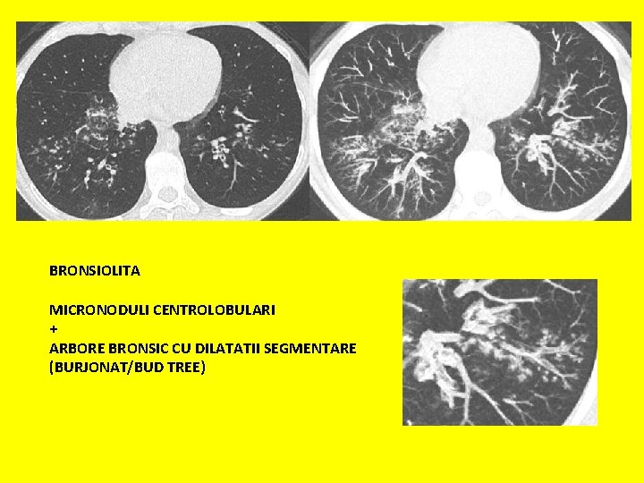 BRONSIOLITA MICRONODULI CENTROLOBULARI + ARBORE BRONSIC CU DILATATII SEGMENTARE (BURJONAT/BUD TREE) 