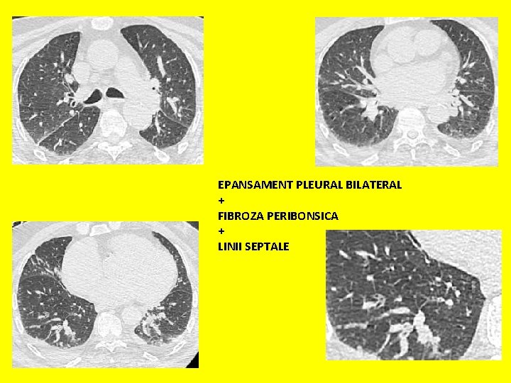 EPANSAMENT PLEURAL BILATERAL + FIBROZA PERIBONSICA + LINII SEPTALE 