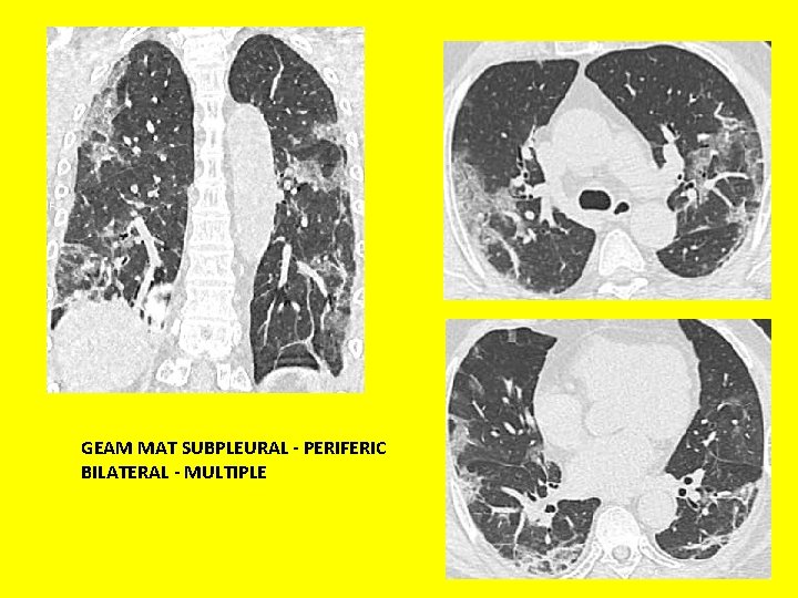 GEAM MAT SUBPLEURAL - PERIFERIC BILATERAL - MULTIPLE 