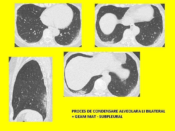 PROCES DE CONDENSARE ALVEOLARA LI BILATERAL + GEAM MAT - SUBPLEURAL 