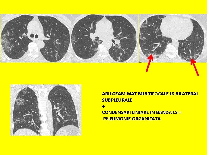 ARII GEAM MAT MULTIFOCALE LS BILATERAL SUBPLEURALE + CONDENSARI LINIARE IN BANDA LS =