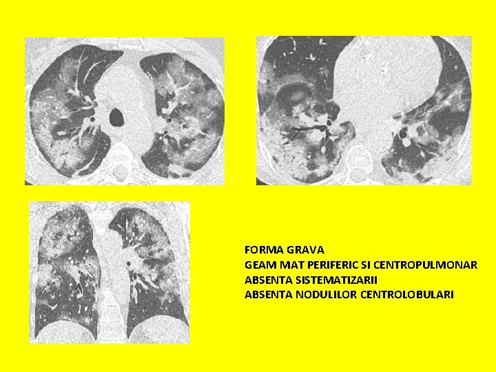 FORMA GRAVA GEAM MAT PERIFERIC SI CENTROPULMONAR ABSENTA SISTEMATIZARII ABSENTA NODULILOR CENTROLOBULARI 