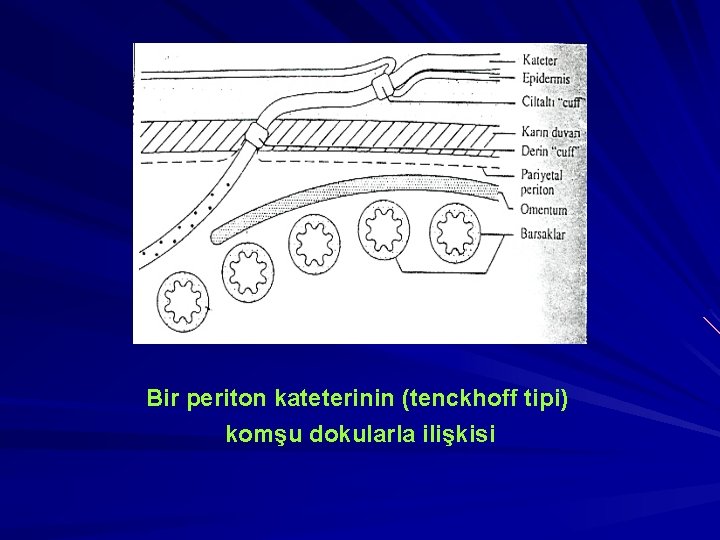 Bir periton kateterinin (tenckhoff tipi) komşu dokularla ilişkisi 