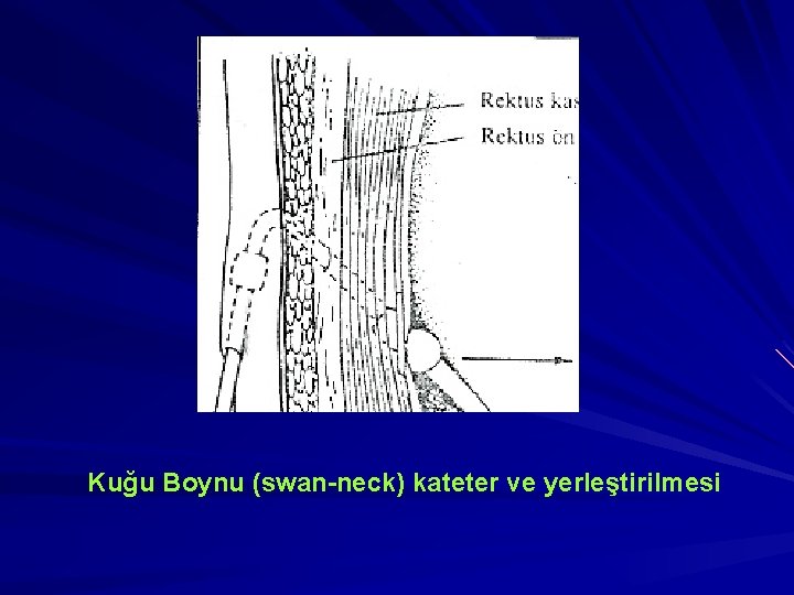 Kuğu Boynu (swan-neck) kateter ve yerleştirilmesi 