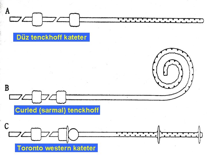 Düz tenckhoff kateter Curled (sarmal) tenckhoff Toronto western kateter 