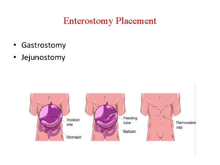 Enterostomy Placement • Gastrostomy • Jejunostomy 