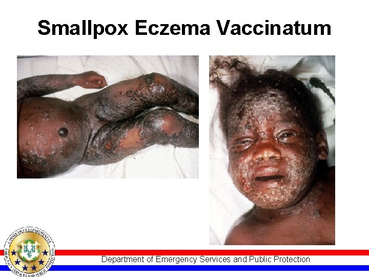 Smallpox Eczema Vaccinatum Department of Emergency Services and Public Protection 