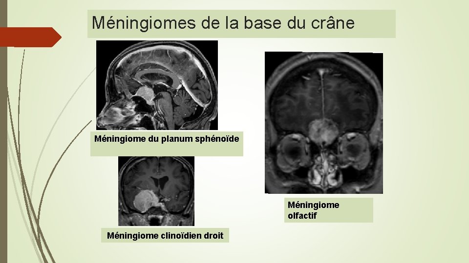 Méningiomes de la base du crâne Méningiome du planum sphénoïde Méningiome olfactif Méningiome clinoïdien