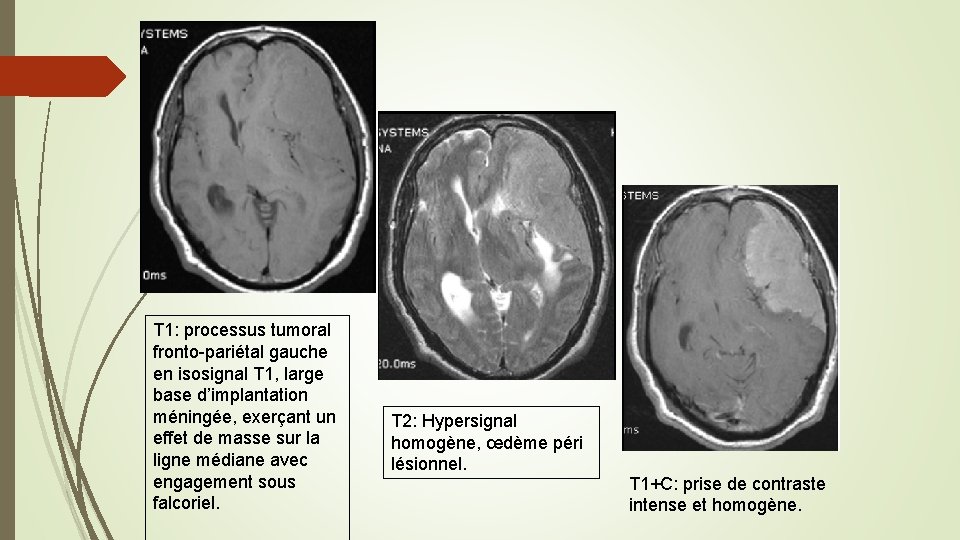 T 1: processus tumoral fronto-pariétal gauche en isosignal T 1, large base d’implantation méningée,