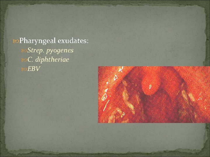  Pharyngeal exudates: Strep. pyogenes C. diphtheriae EBV 