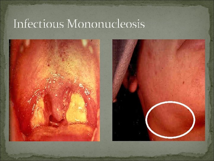 Infectious Mononucleosis 
