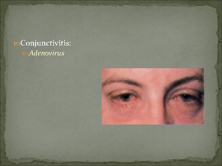 Conjunctivitis: Adenovirus 