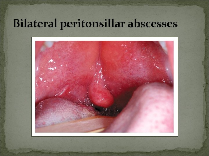 Bilateral peritonsillar abscesses 