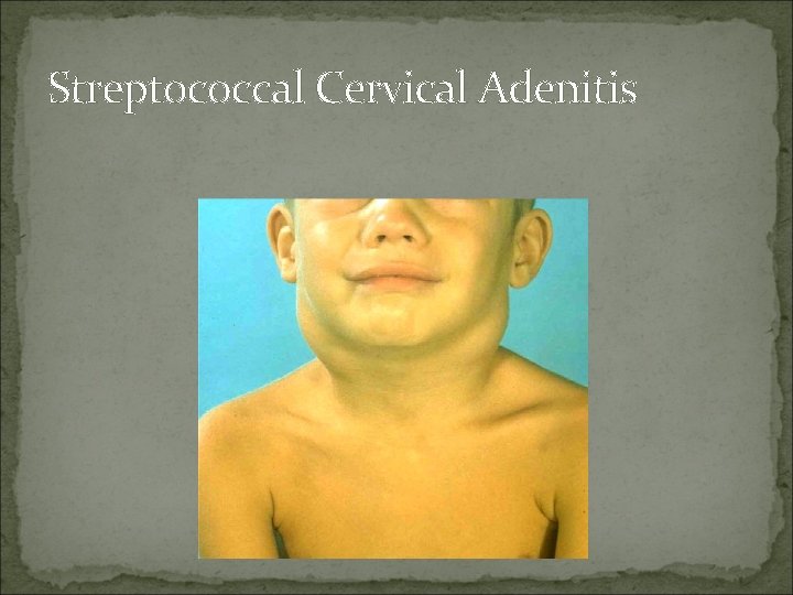 Streptococcal Cervical Adenitis 