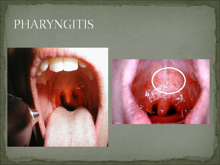 PHARYNGITIS 