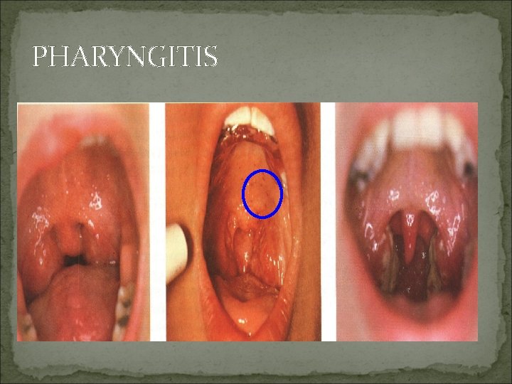 PHARYNGITIS 