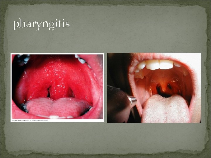 pharyngitis 