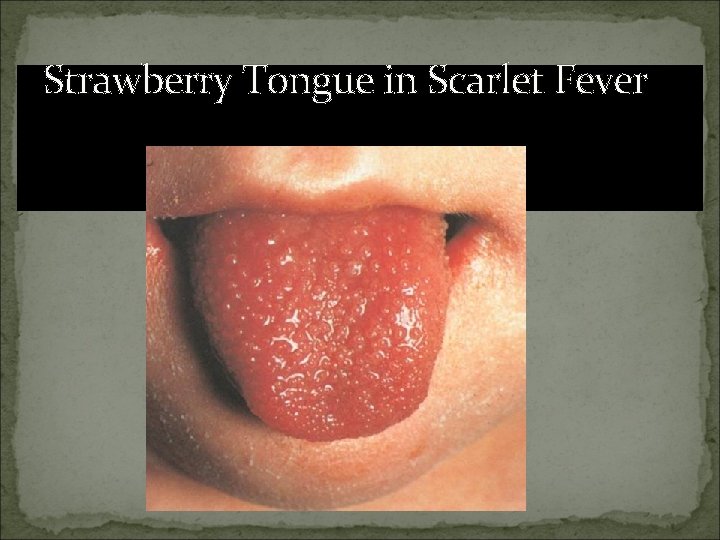 Strawberry Tongue in Scarlet Fever 
