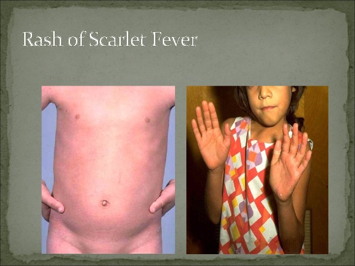 Rash of Scarlet Fever 