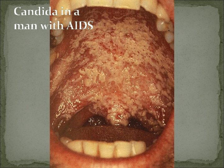 Candida in a man with AIDS 