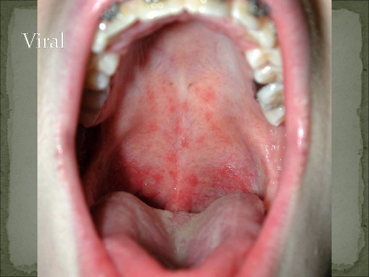 Viral 