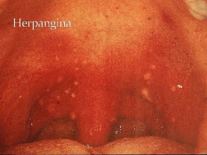 Herpangina 