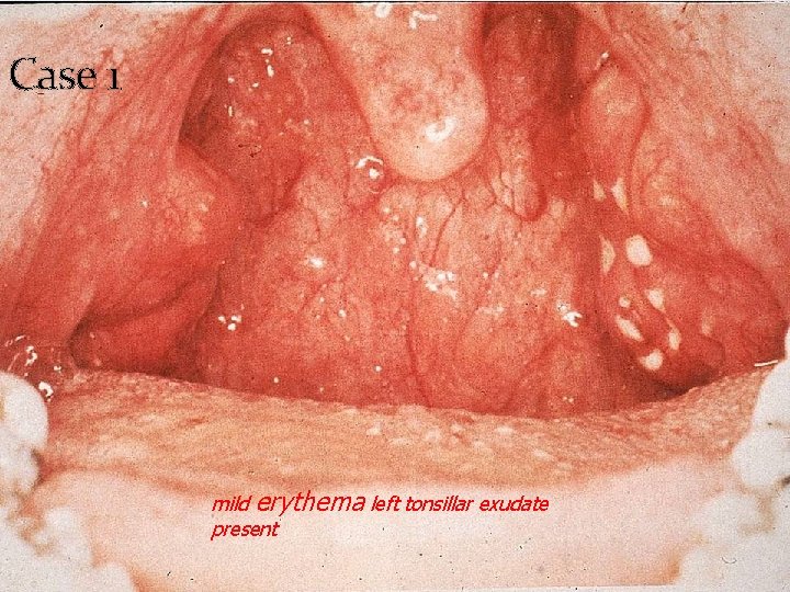 Case 1 mild erythema left tonsillar exudate present 