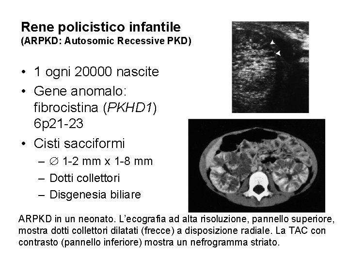 Rene policistico infantile (ARPKD: Autosomic Recessive PKD) • 1 ogni 20000 nascite • Gene