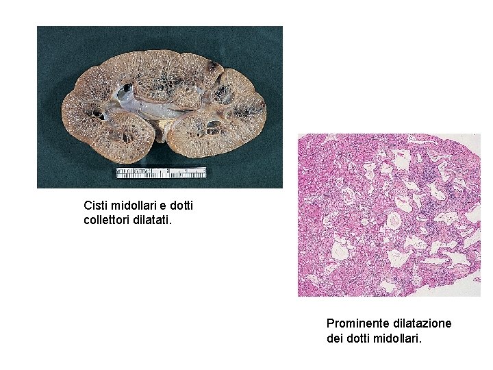 Cisti midollari e dotti collettori dilatati. Prominente dilatazione dei dotti midollari. 