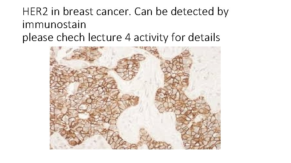 HER 2 in breast cancer. Can be detected by immunostain please chech lecture 4