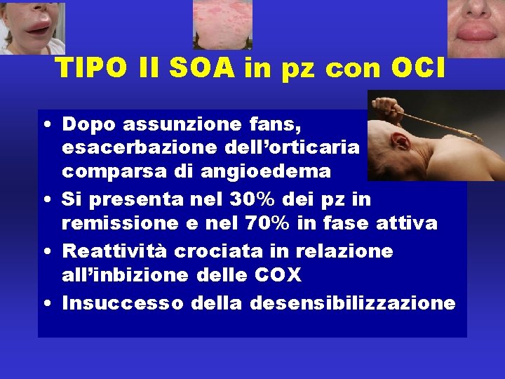 TIPO II SOA in pz con OCI • Dopo assunzione fans, esacerbazione dell’orticaria con